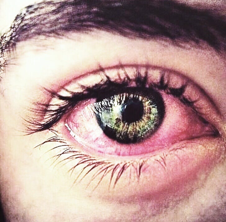 Why does smoking weed cause red eyes?